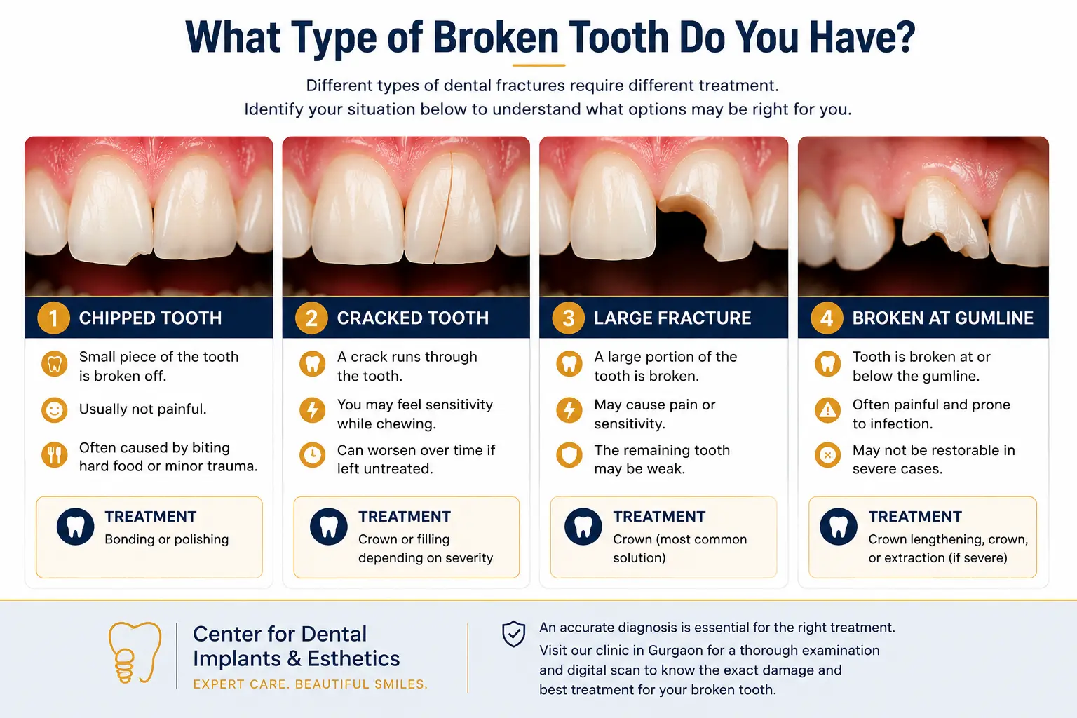 Different types of broken tooth — chipped, cracked, fractured and treatment guide Gurgaon