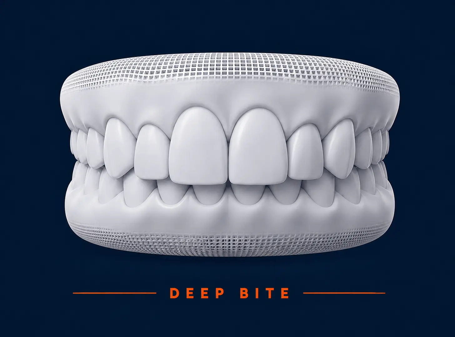 deep bite example