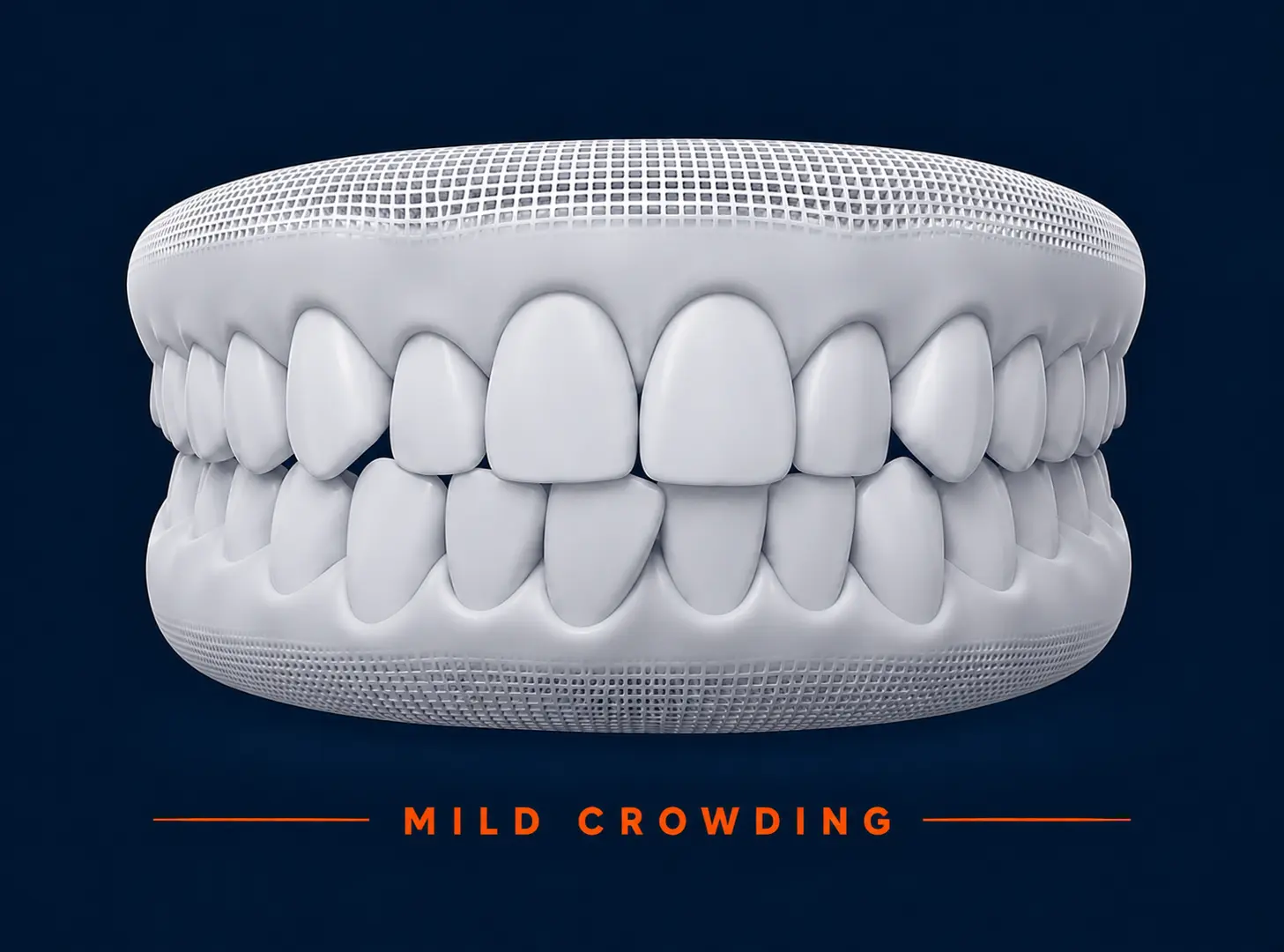 mild crowding crooked teeth example