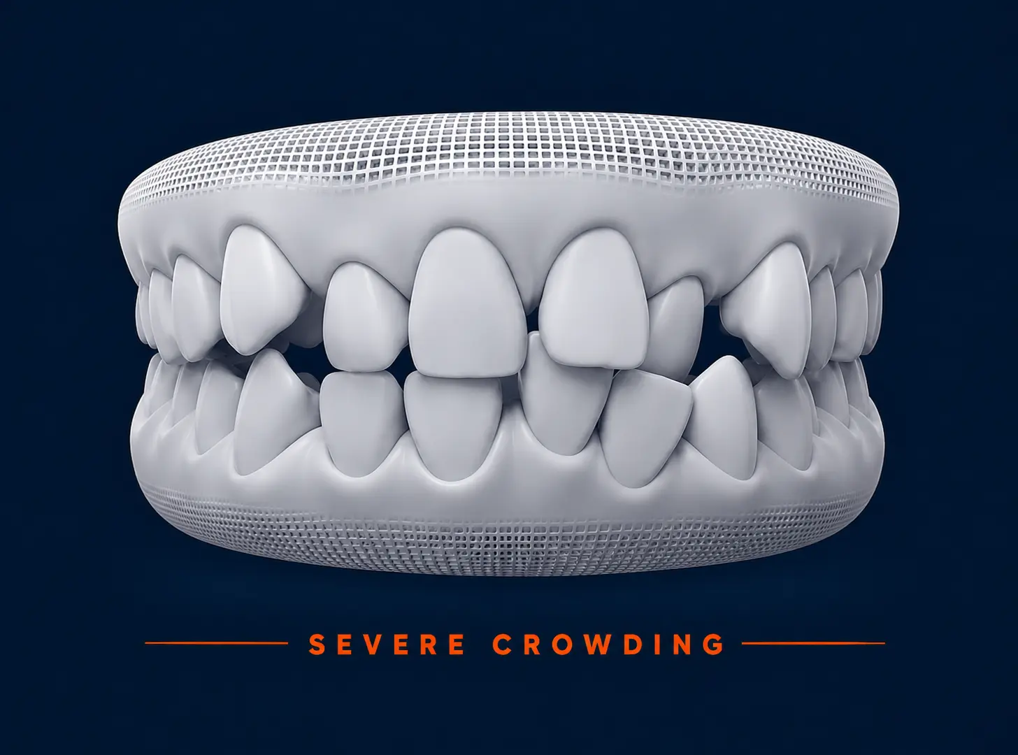 severe crowding crooked teeth example