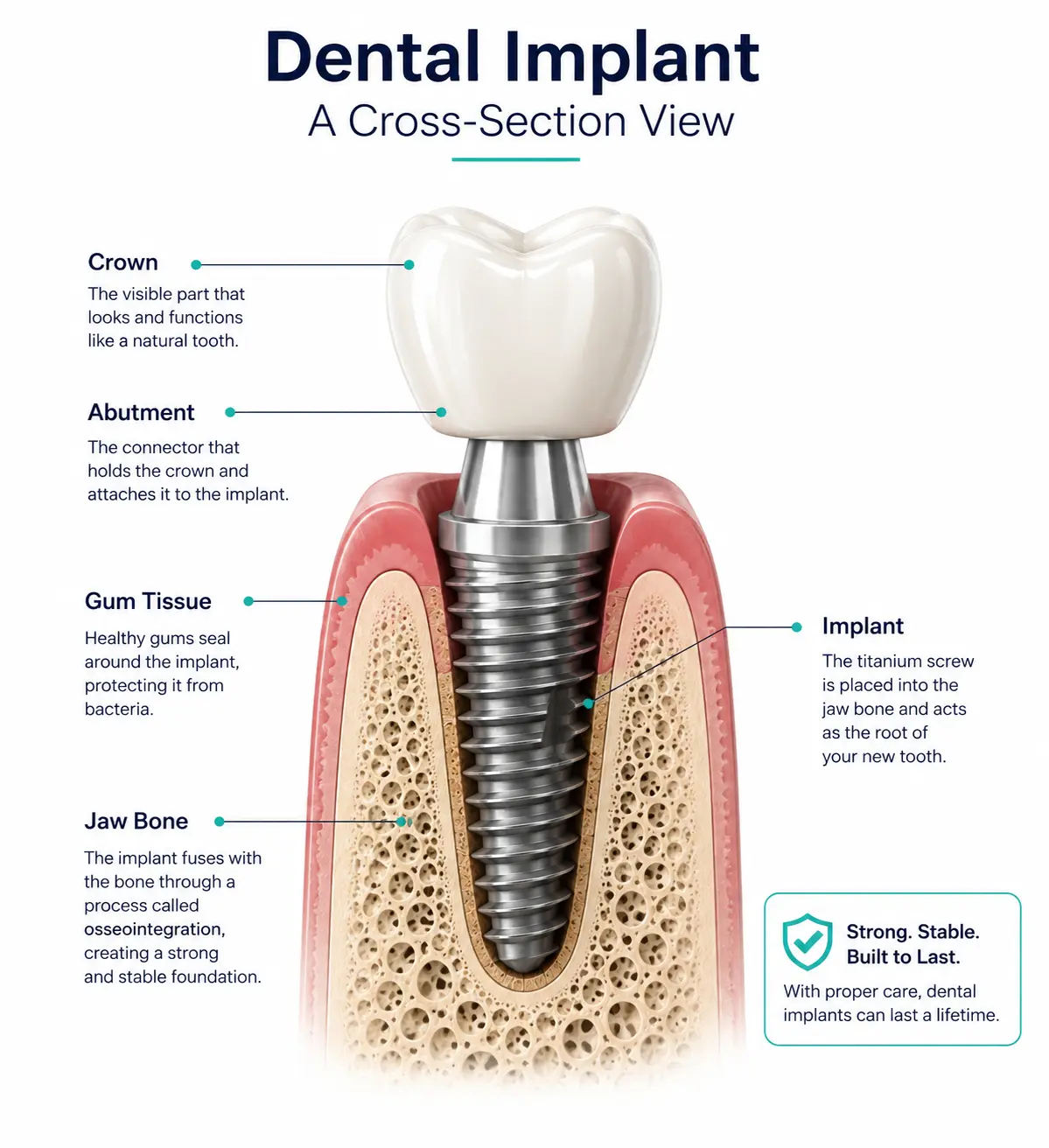 Diagram of dental implant screw healing inside jaw bone