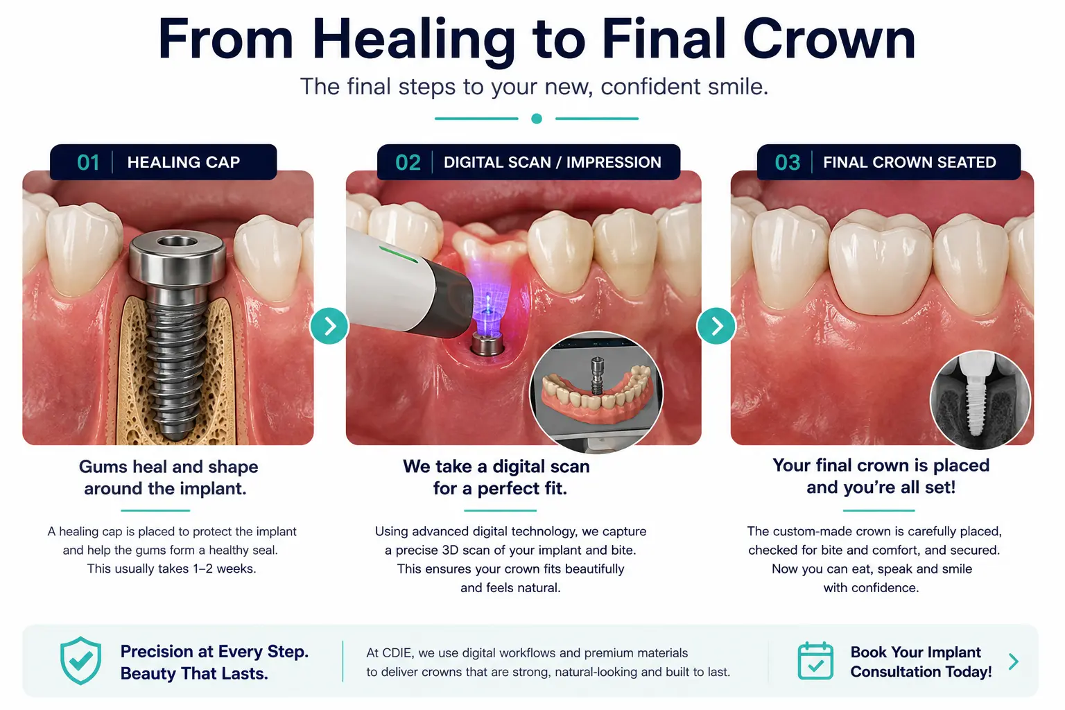 Sequence from healing implant to final crown placement