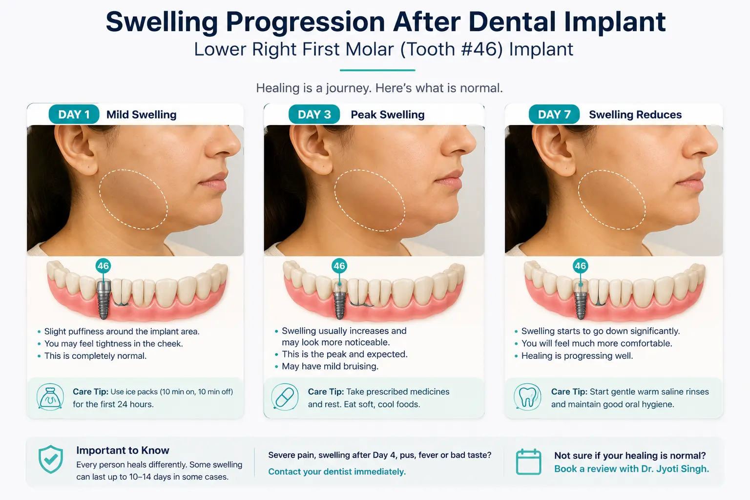 Swelling progression after dental implant surgery, Day 1 to Day 7