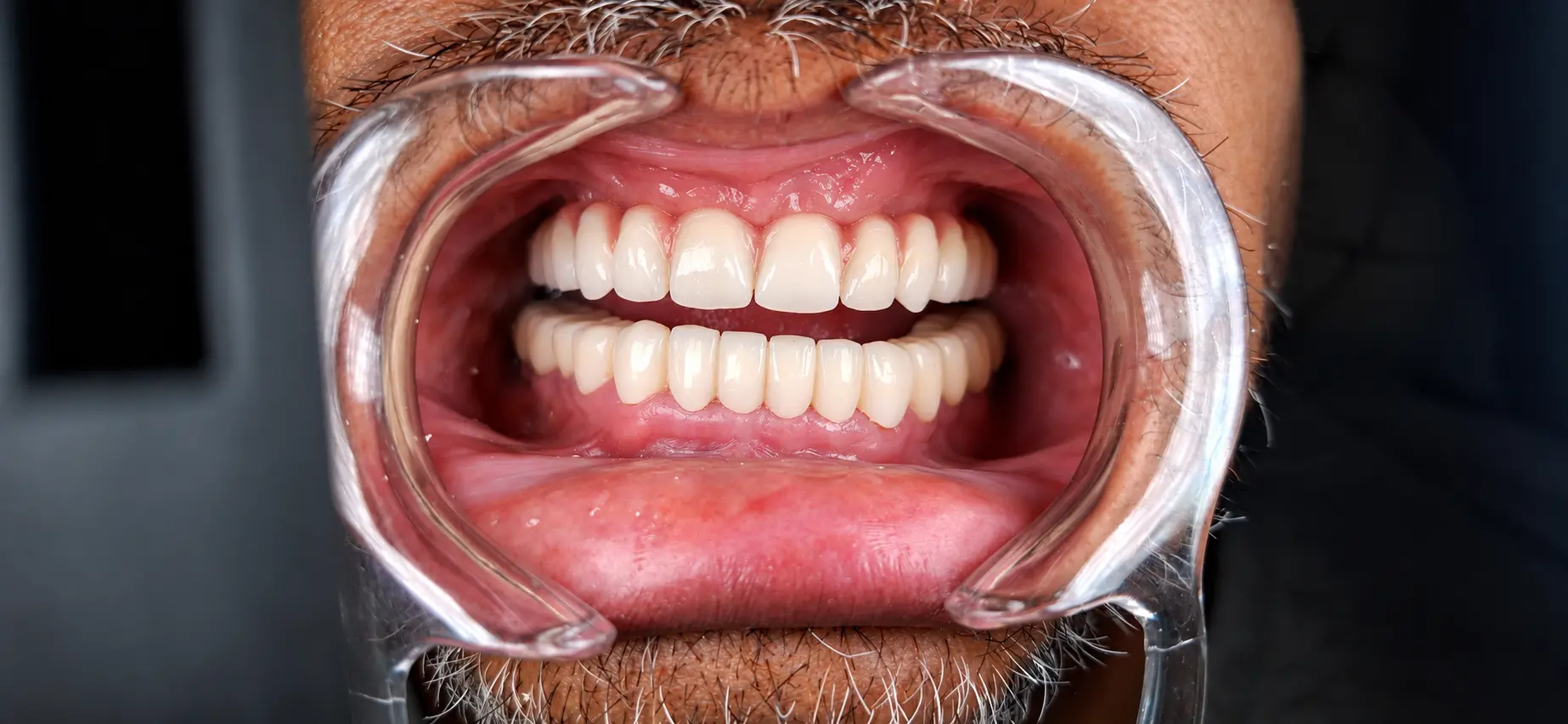 Front view of the final upper bridge and his lower teeth, taken with a cheek retractor
