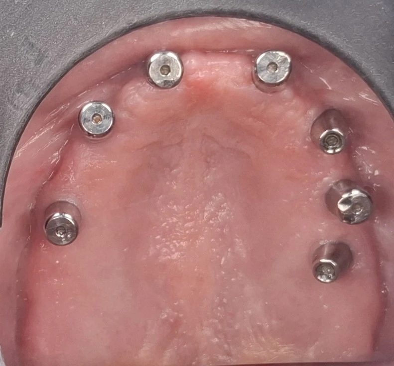 Upper jaw seen from below after surgery with seven implants showing healing caps
