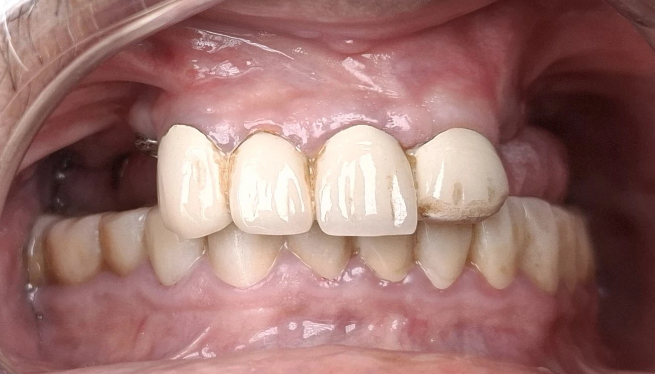 Front view before treatment showing four crowned upper front teeth, no upper back teeth, and the lower teeth