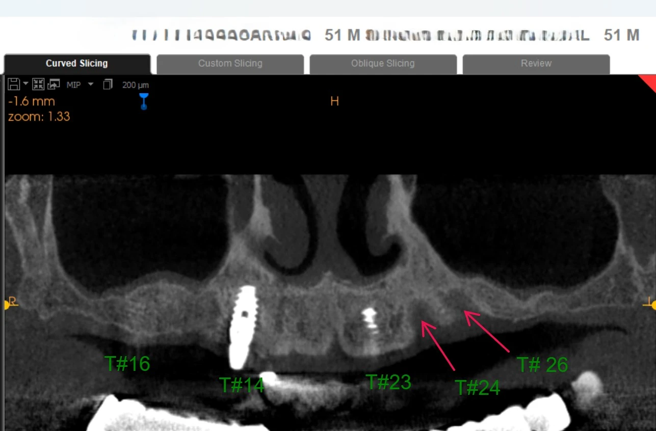 CBCT curved slice of the upper jaw with labels marking the old implant sites and thin bone below the sinus