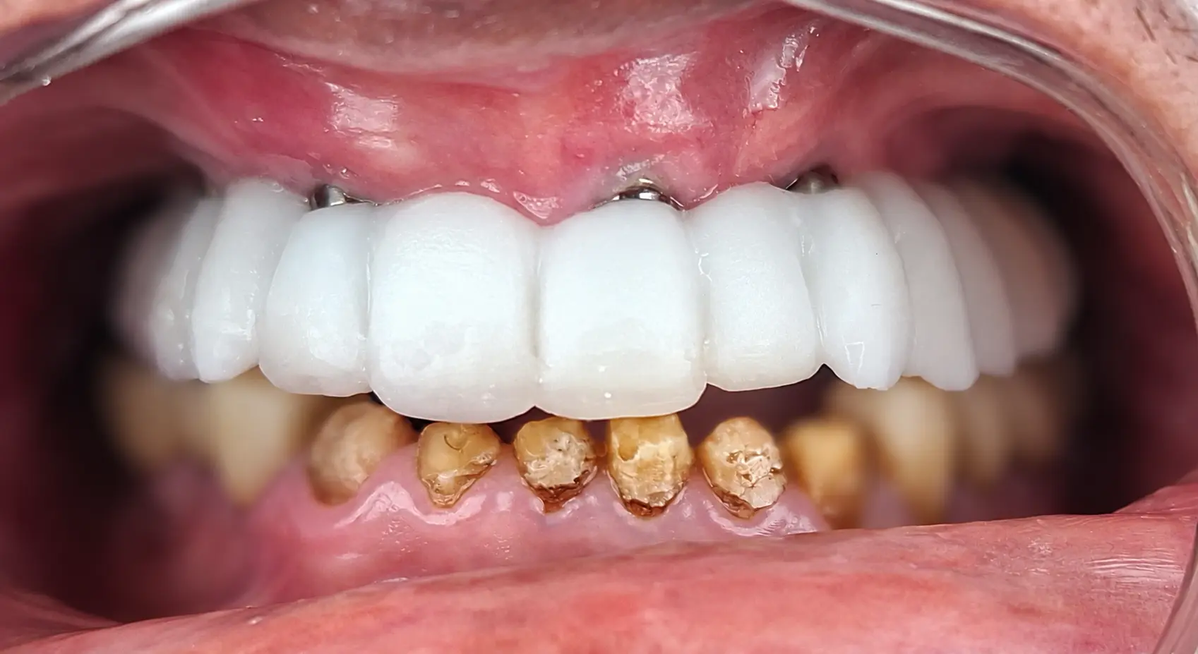 3D-printed trial teeth fitted over the implants to test smile and bite, front view